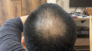 頭頂部植毛3000グラフト経過まとめ｜術後1日〜現在までを全公開