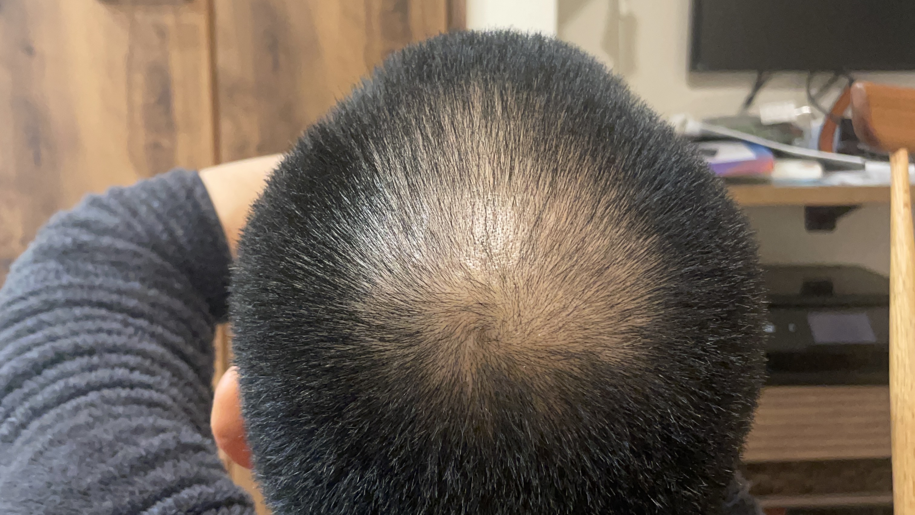 hair-transplant-day-1
