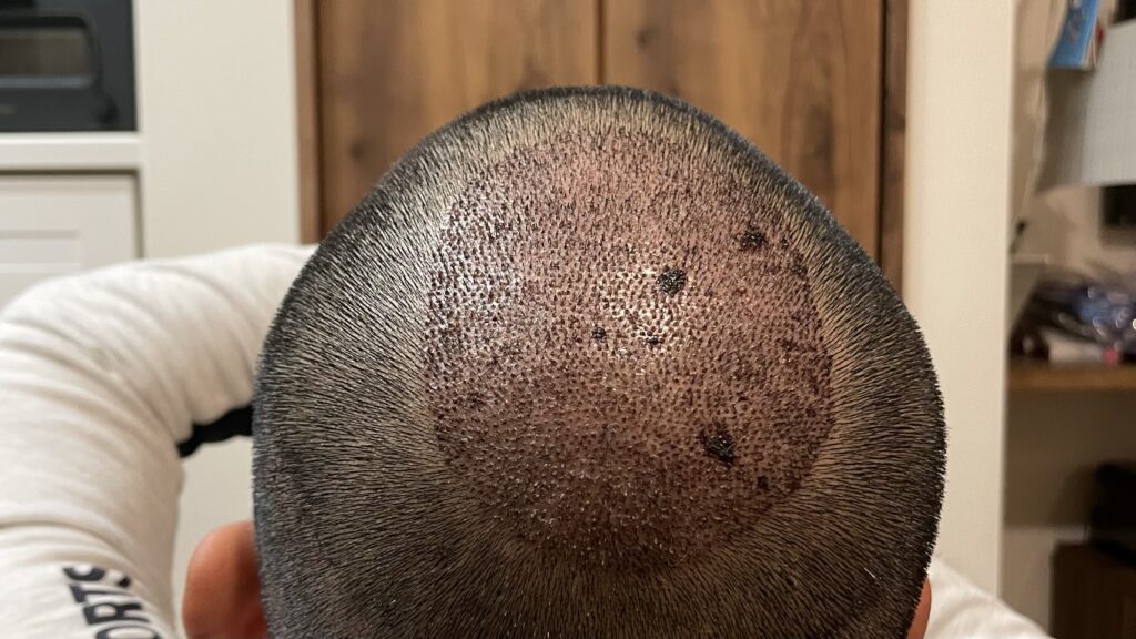 hair-transplant-day3