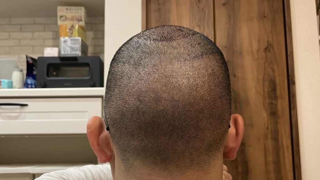 hair-transplant-day3-back