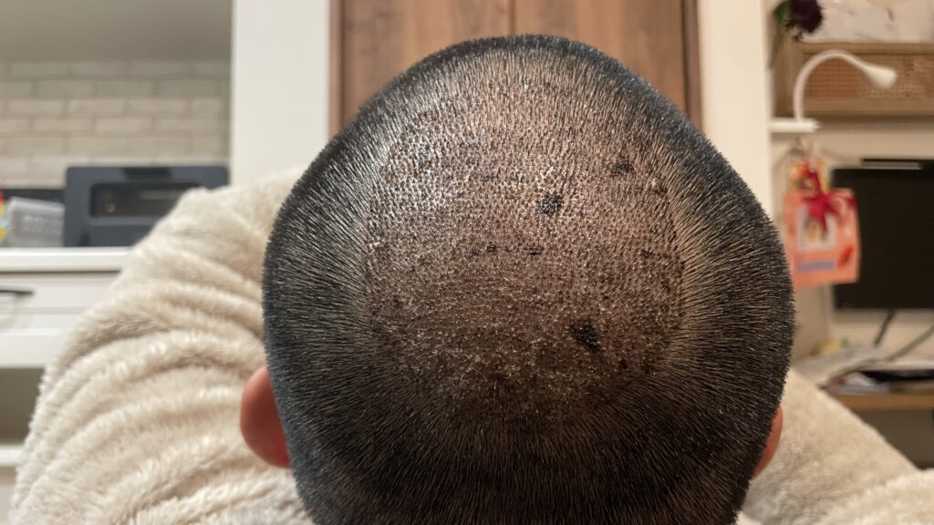hair-transplant-day6
