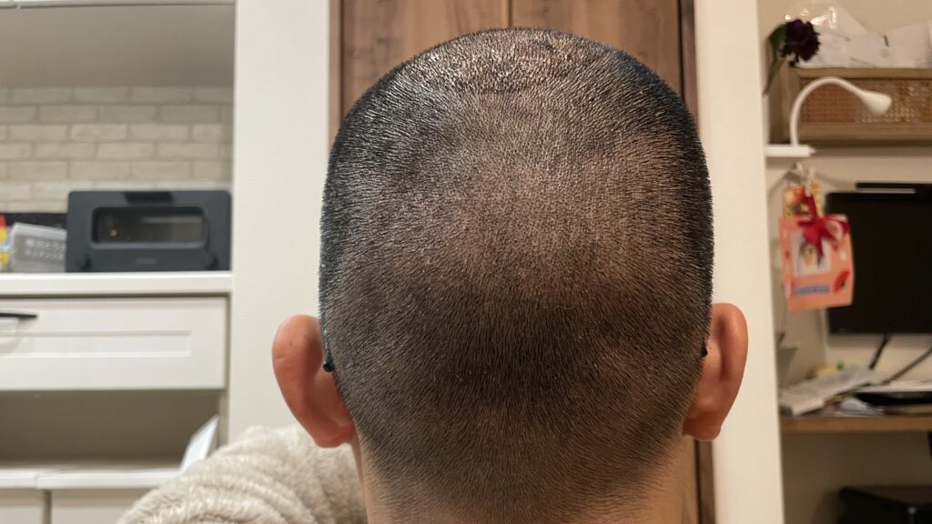 hair-transplant-day6-back