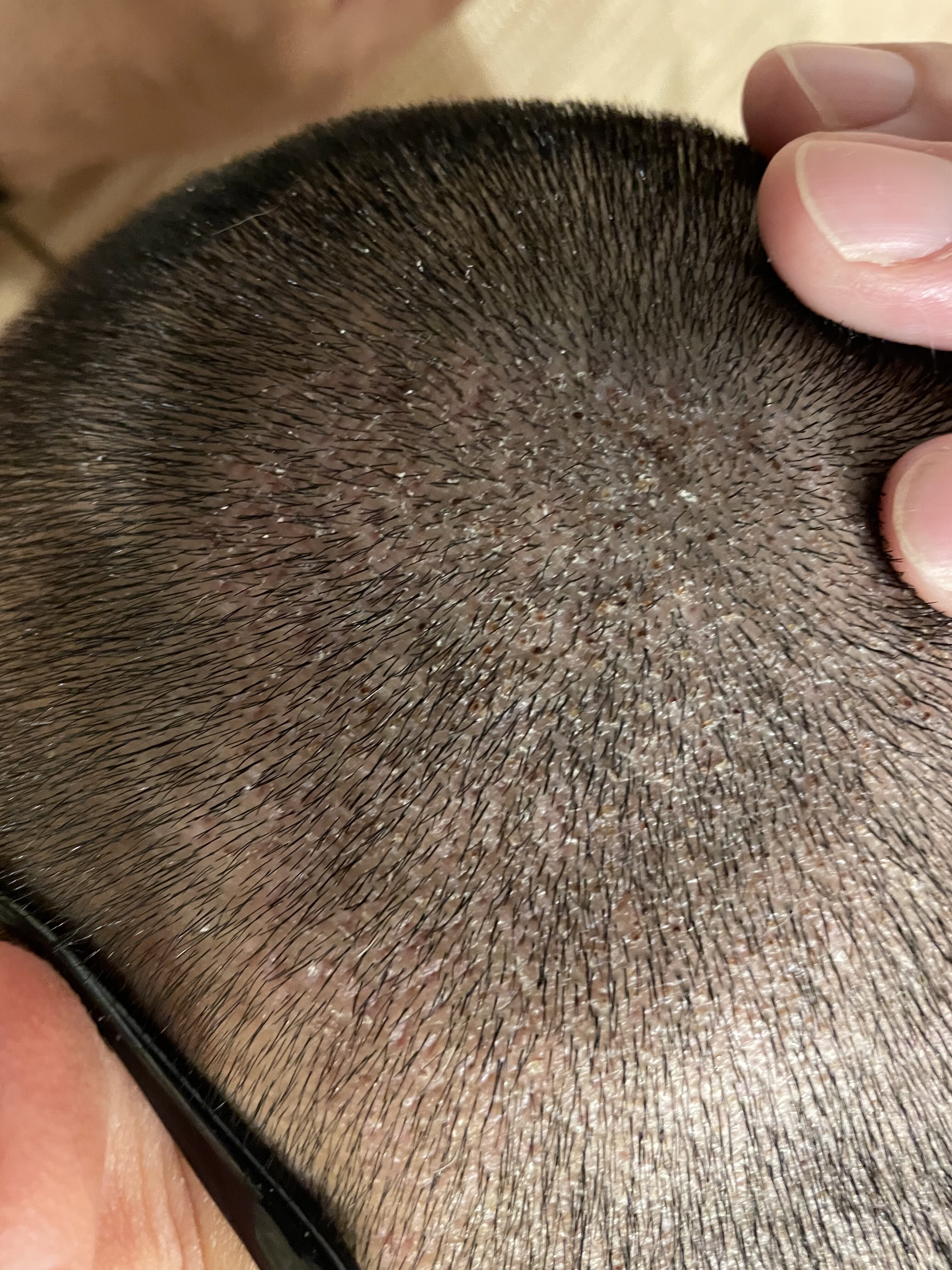hair-transplant-day6-side-up