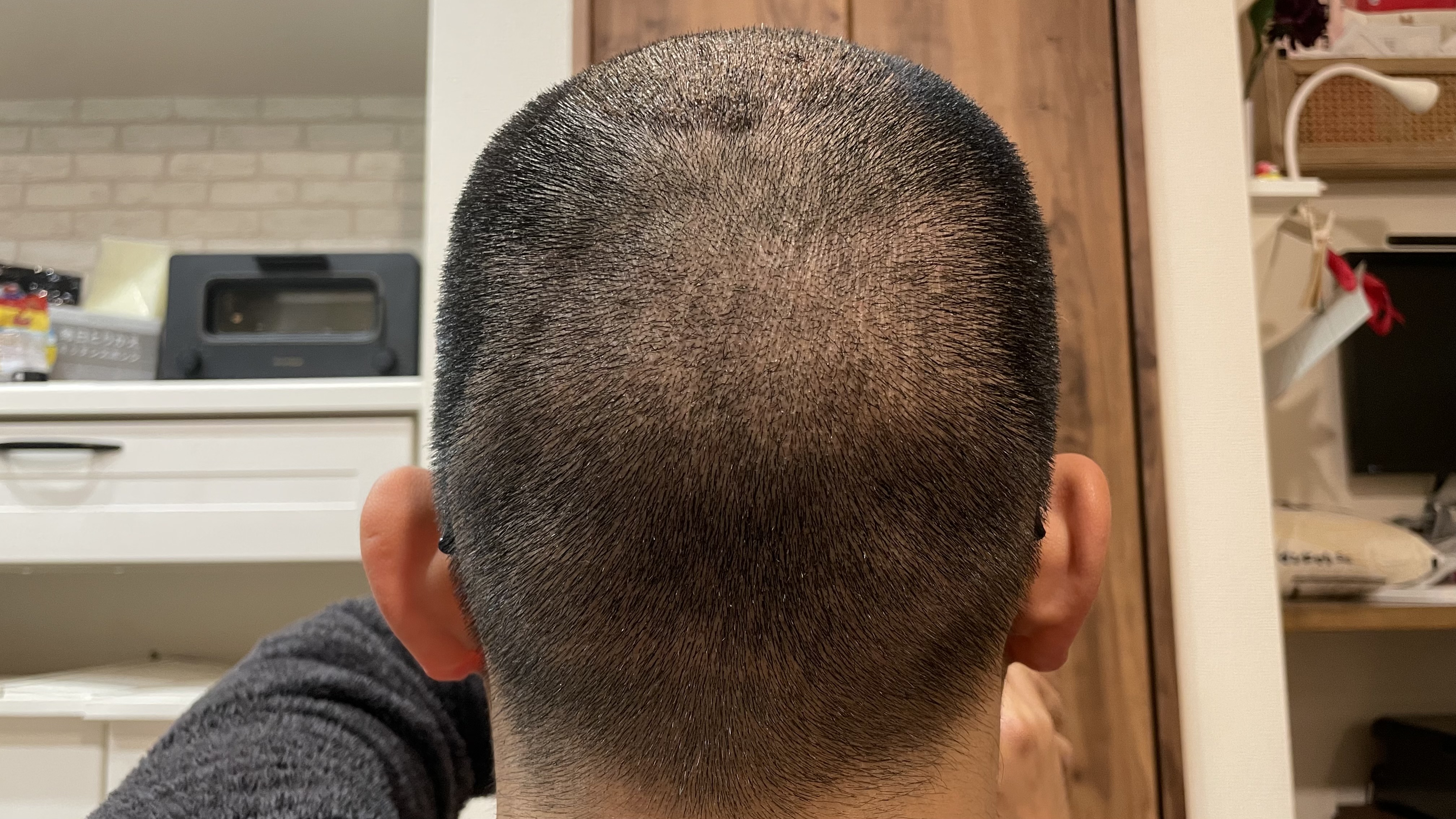 hair-transplant-day9-back