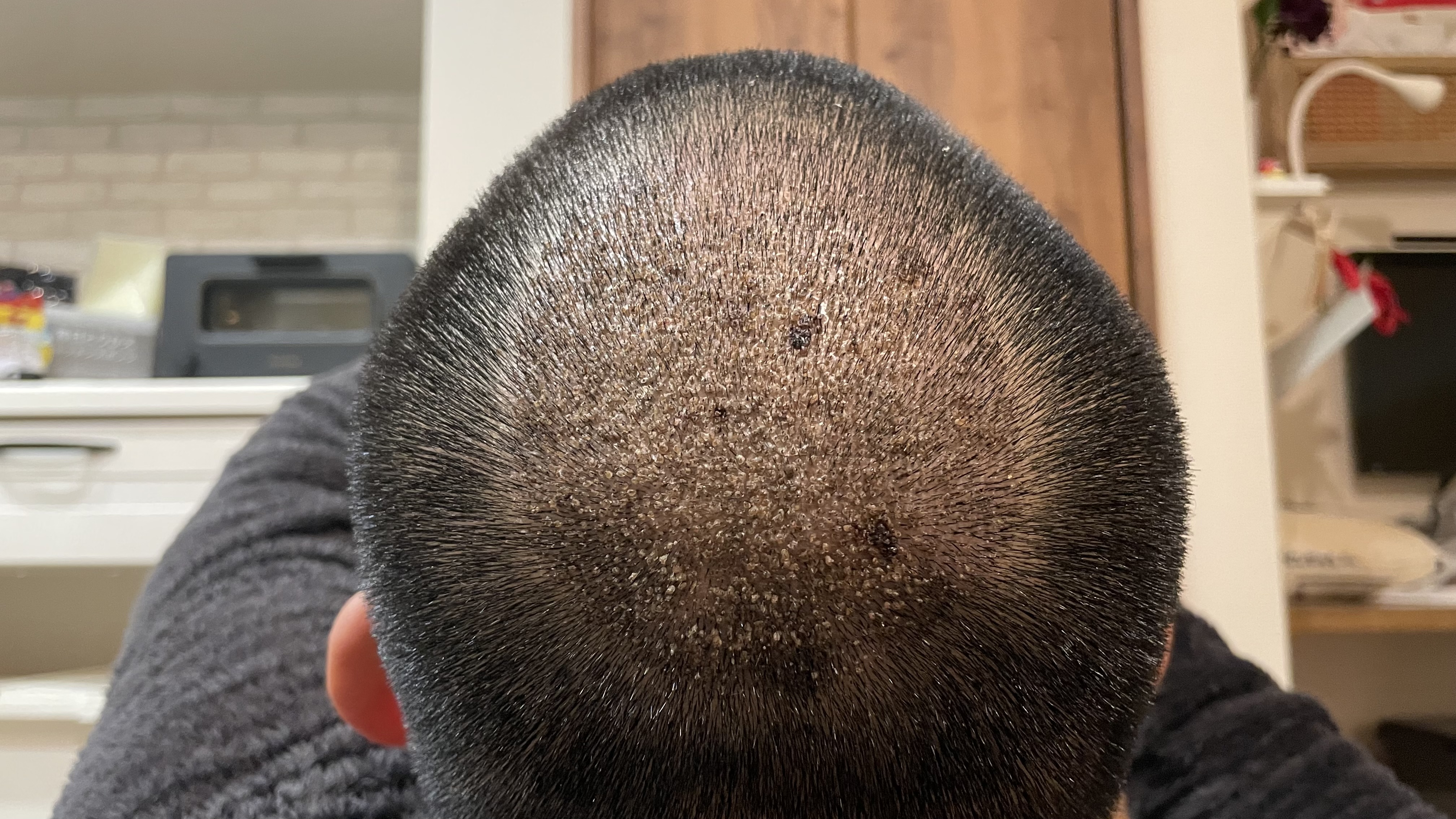 hair-transplant-day9