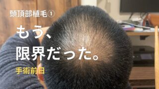 【頭頂部植毛①】薄毛が限界で植毛しました。これがスタートです（費用200万の決断）