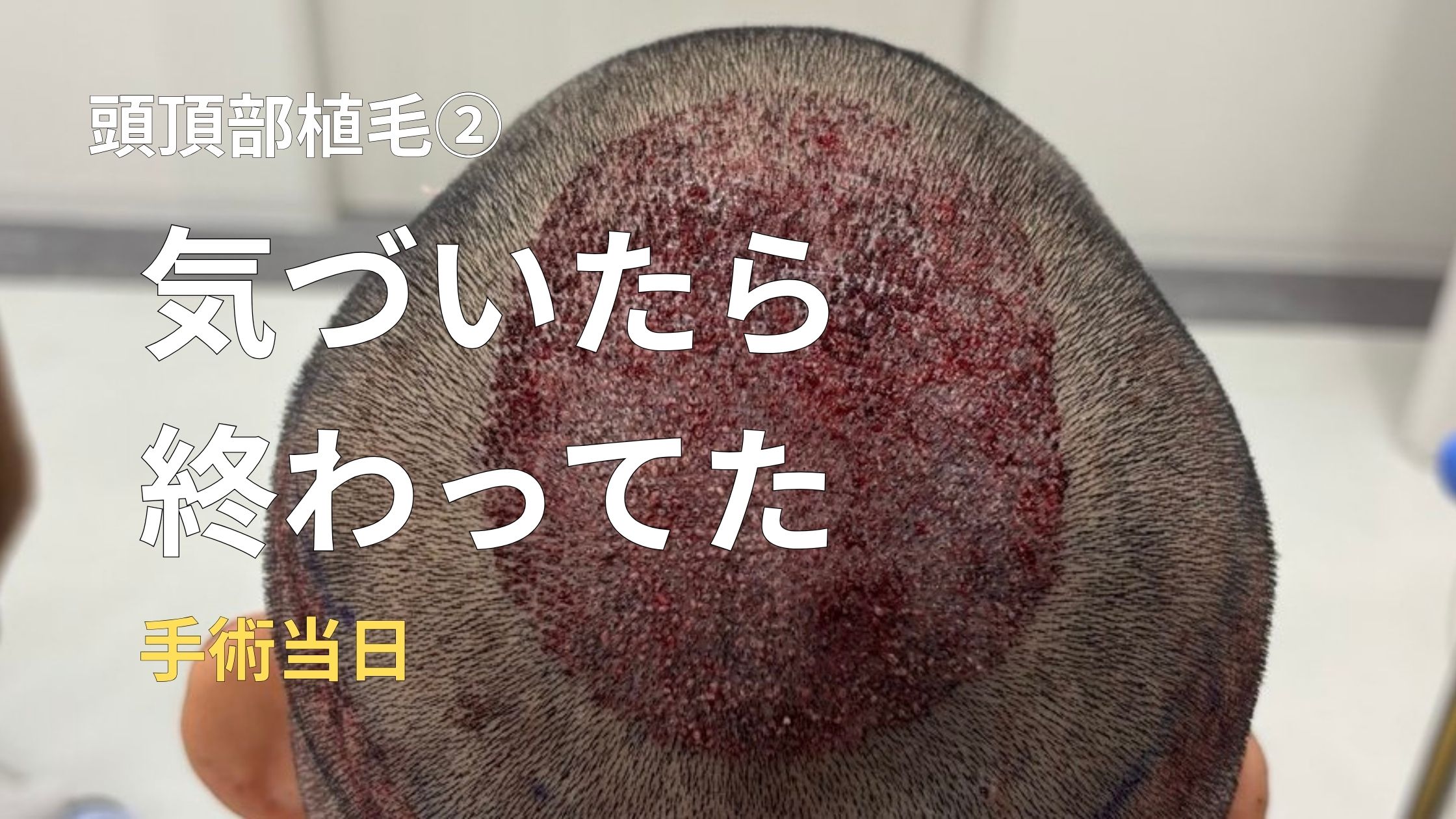 hair-transplant-no0