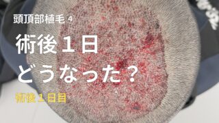 【頭頂部植毛④】植毛術後1日目はどんな状態？痛み・見た目・ダウンタイムをリアル解説