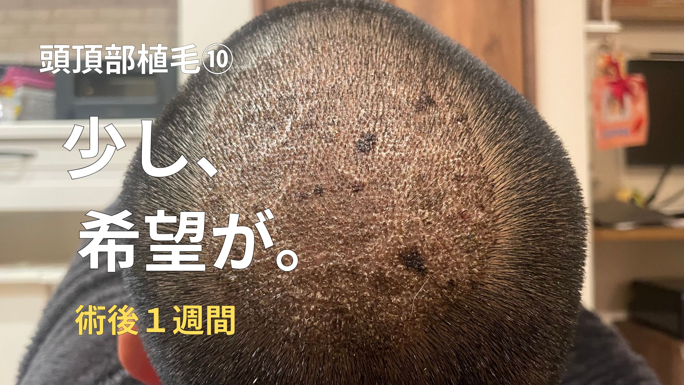 【頭頂部植毛⑩】植毛術後１週間｜瘡蓋が割れてきた。少しだけ希望が見えてきた？