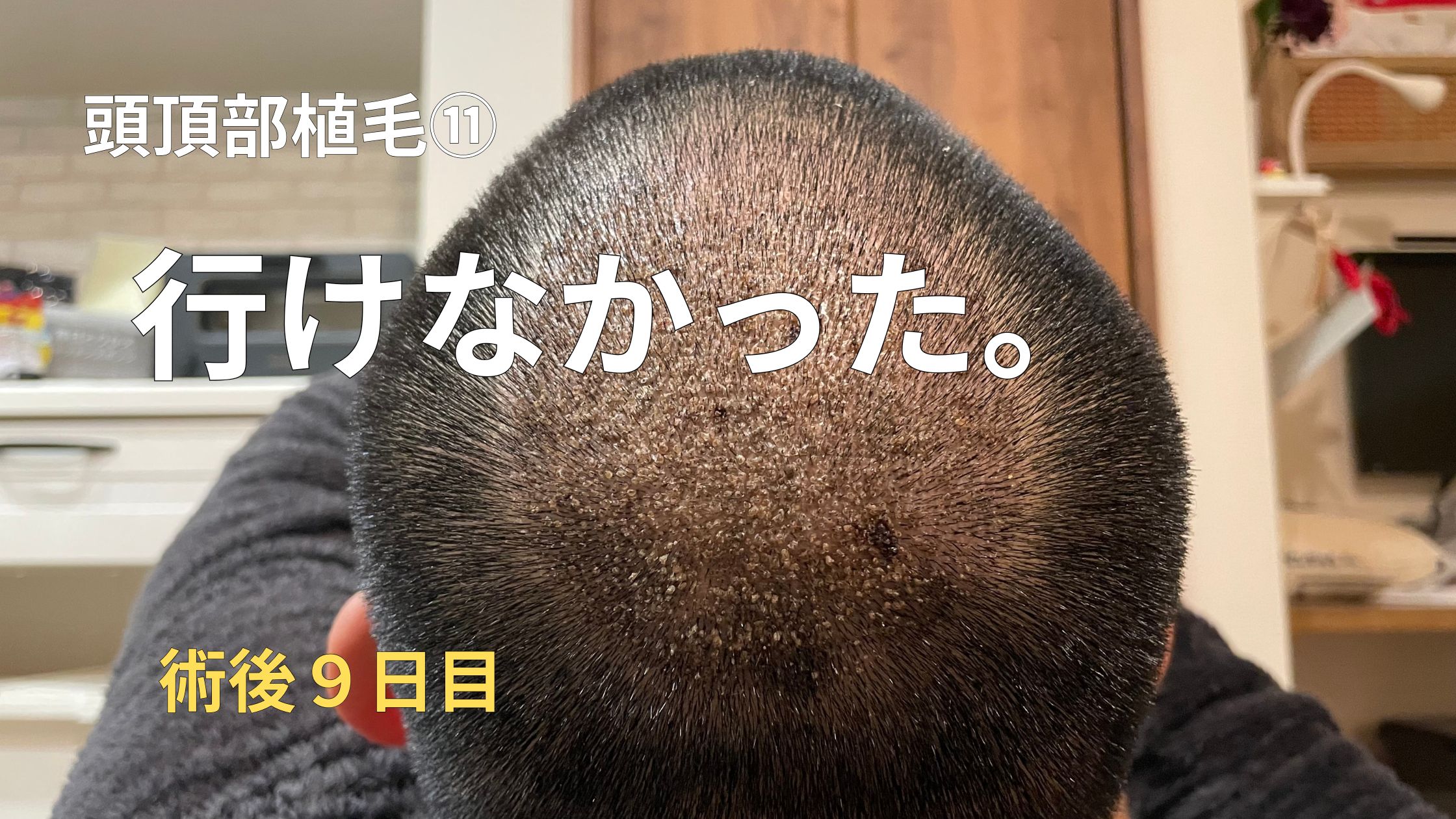 【頭頂部植毛⑪】植毛術後9日目｜仕事復帰できない…頭頂部＋坊主のダウンタイムが想像以上だった