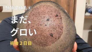 【頭頂部植毛⑤】植毛術後2日目はどうなる？痛み・赤み・シャンプーのリアル経過
