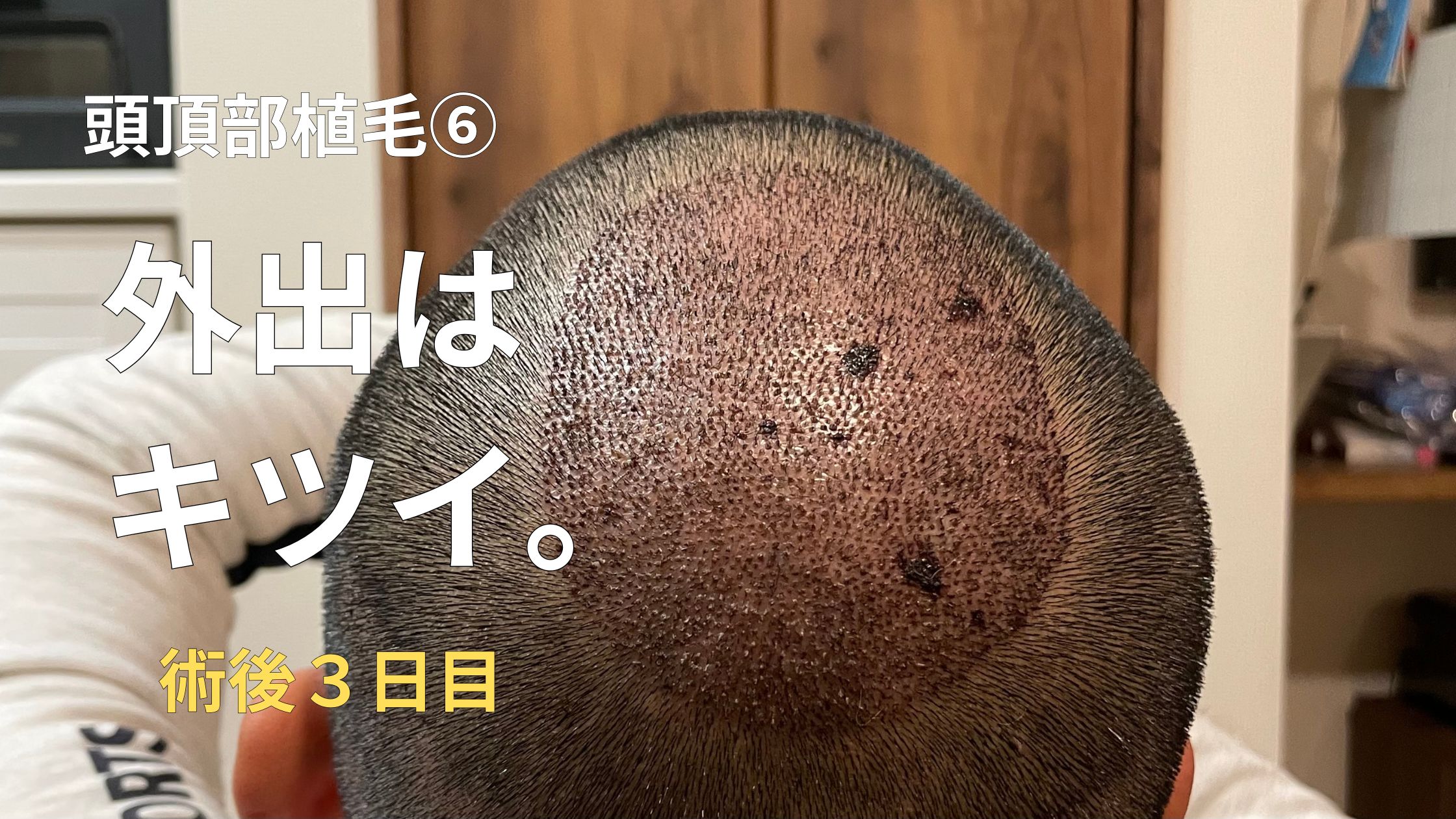 hair-transplant-no6