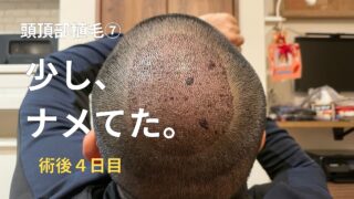 【頭頂部植毛⑦】植毛術後4日目はどうなる？痛み・腫れ・仕事復帰のリアル