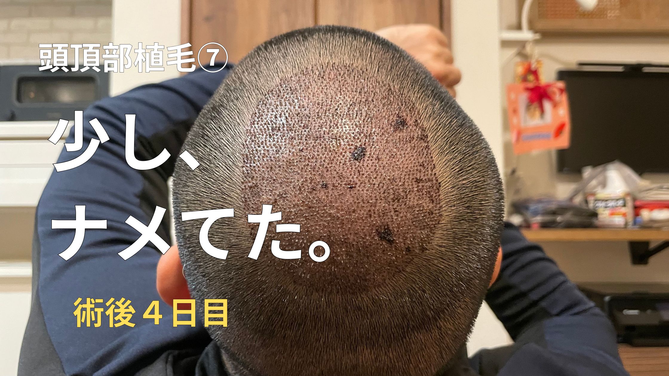 hair-transplant-no7