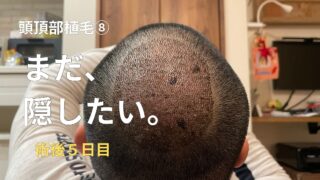 頭頂部植毛⑧】植毛術後5日目はどうなる？回復感はある。でも普通にバレる