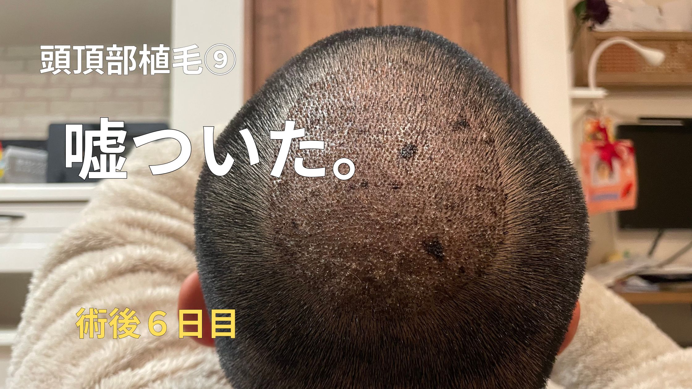 ▶︎【頭頂部植毛⑨】植毛術後6日目｜仕事復帰したけど、植毛したとは言えなかった