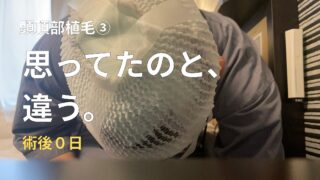 頭頂部植毛③】植毛の痛みはどれくらい？3000グラフト術後のリアル経過
